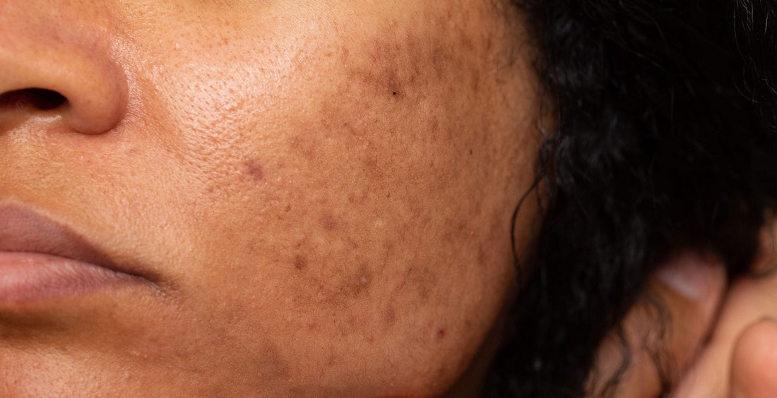 7 Formas de Mantener a Raya el Melasma Facial y el Tono de Piel Irregular