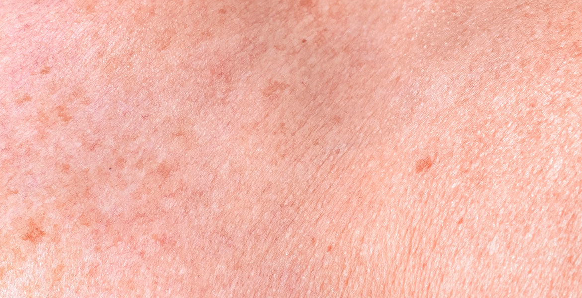El melasma y cómo tratarlo
